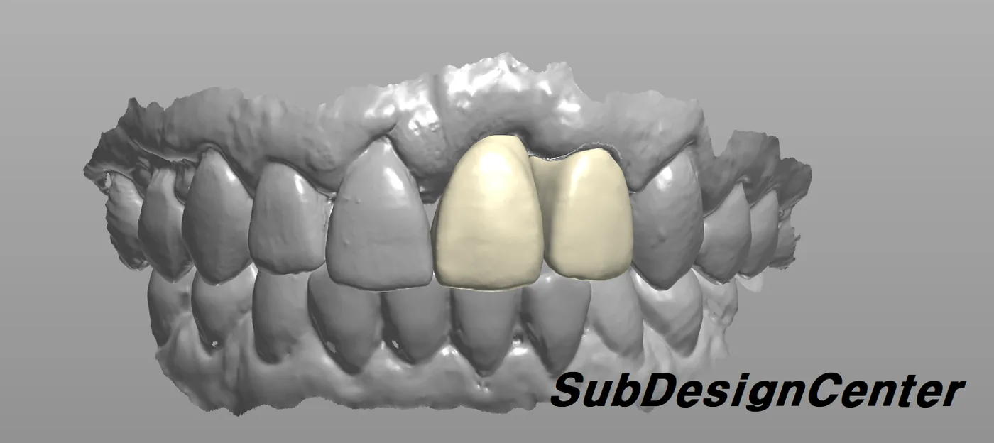 CAD design: anterior crowns with esthetic tooth anatomy