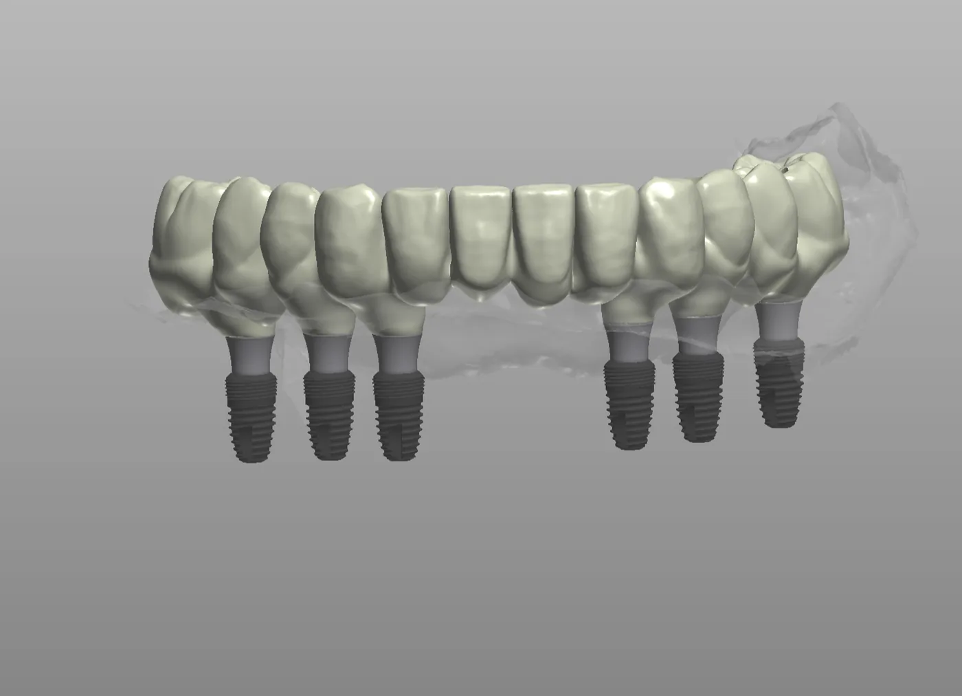 CAD design: full-arch implant bridge supported by six implants