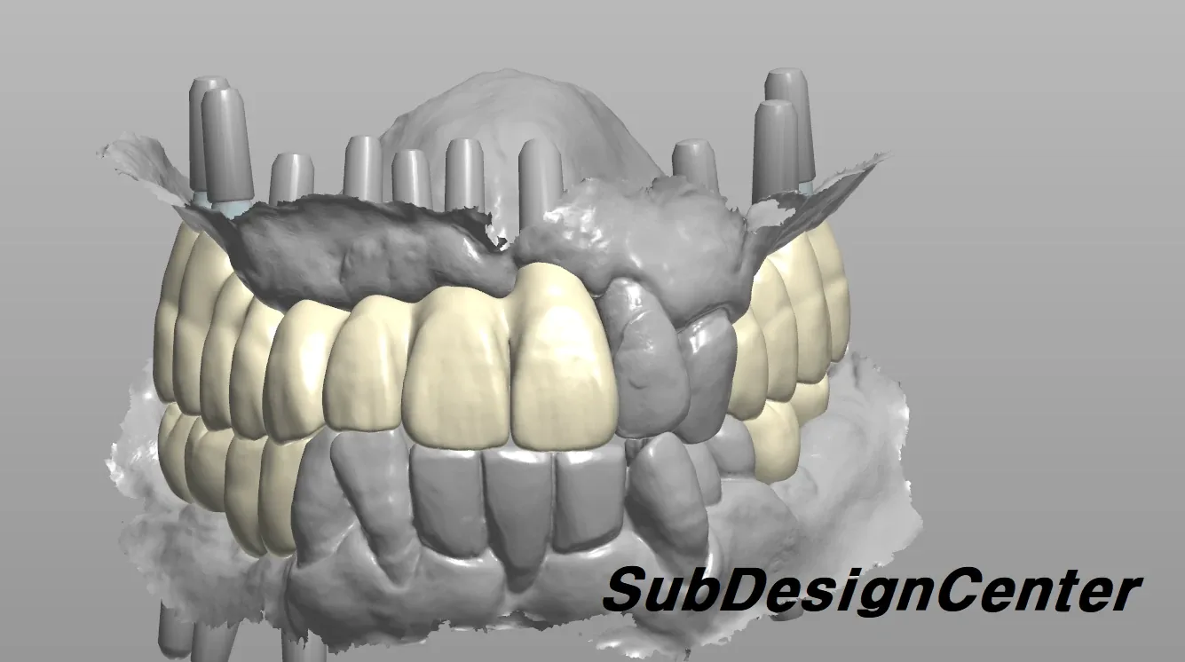 CAD design: full-arch implant prostheses for the upper and lower arches