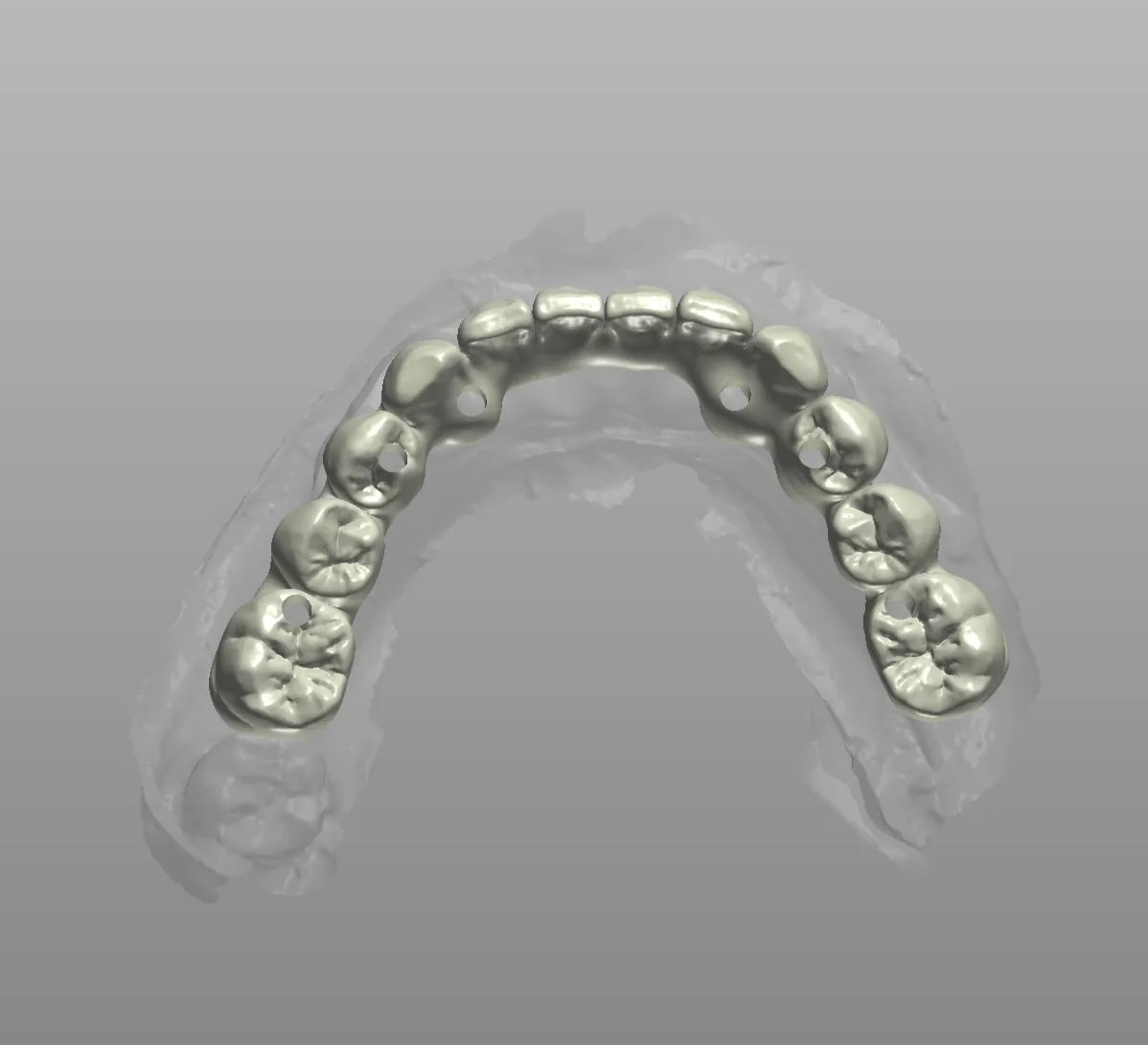 CAD design: screw-retained full-arch restoration, occlusal view