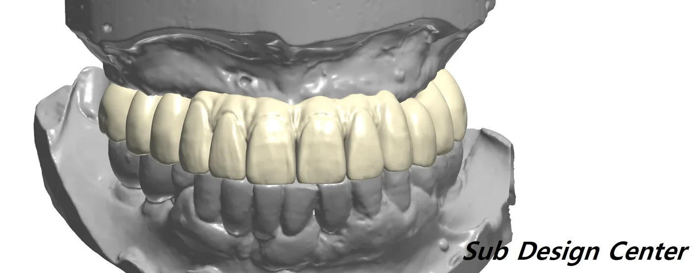 CAD design: full-arch restoration shown in occlusion